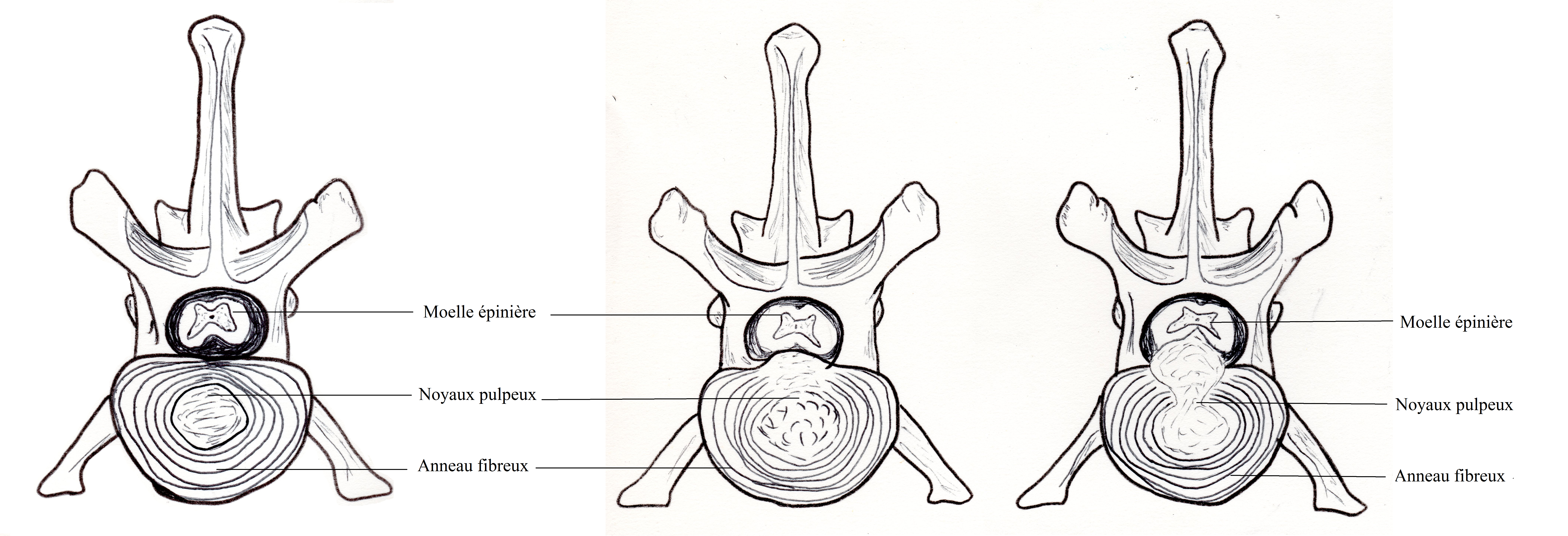 schéma ddes hernies discales